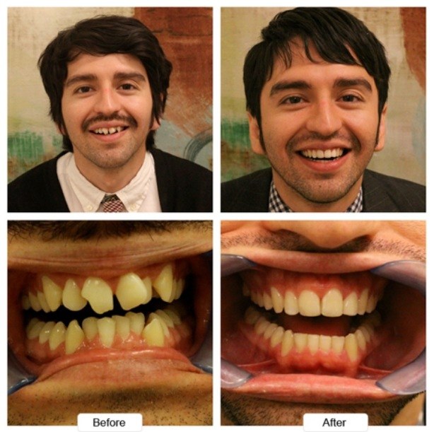 Man with mustache smiling before and after Invisalign treatment