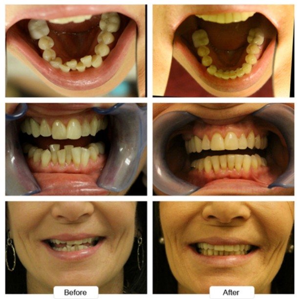 Close up of crooked teeth before and after Invisalign