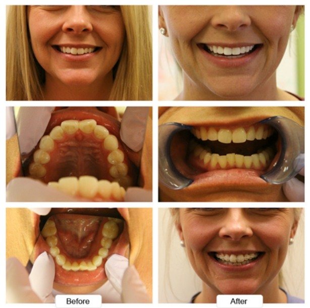 Young blonde woman grinning before and after Invisalign