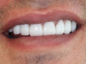 Smile with normal sized teeth after cosmetic dentistry