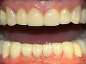 Close up of brighter repaired teeth
