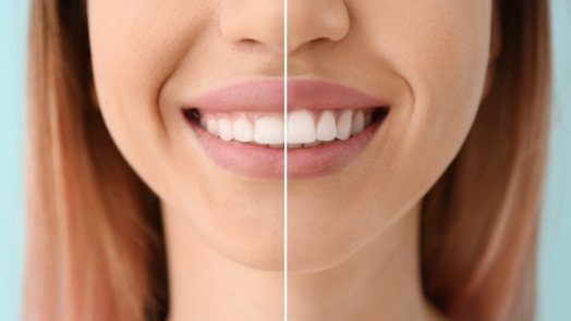 WOman smiling before and after correcting gummy smile