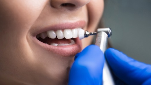 Close up of person getting their teeth cleaned