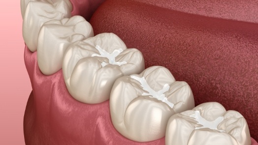 Illustrated row of teeth with dental sealants