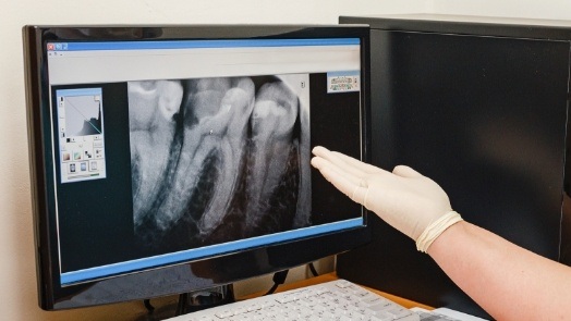 Gloved hand gesturing to computer screen showing x rays of teeth