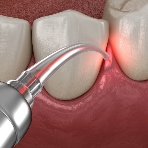 Illustrated dental laser treating diseased gums