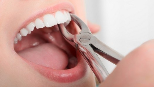 Close up of dental patient having a tooth extracted