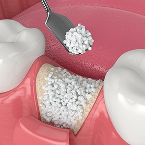 a 3D illustration showing a dental bone graft