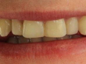Close up of evenly sized front teeth after dental bonding