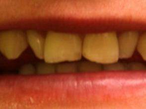 Close up of chipped front teeth