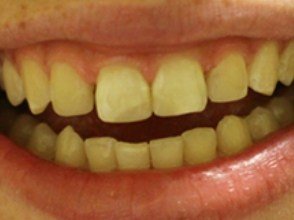 Close up of evenly spaced teeth after dental bonding