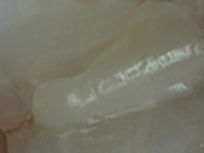 Close up of tooth after cracked tooth treatment