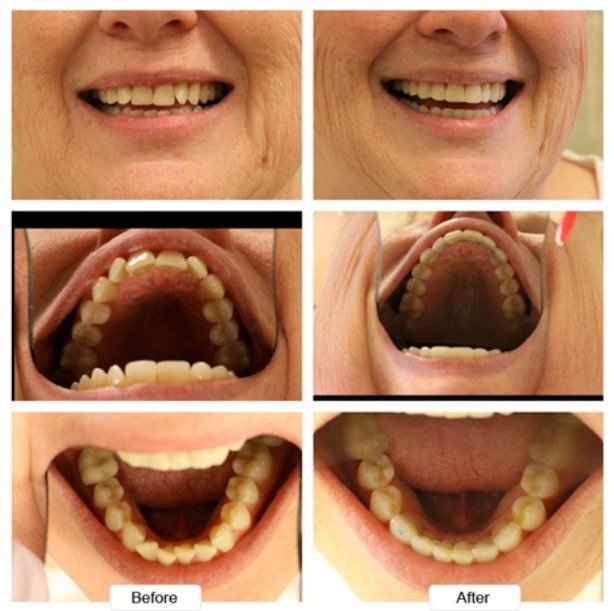 Close up of teeth before and after being aligned with Invisalign