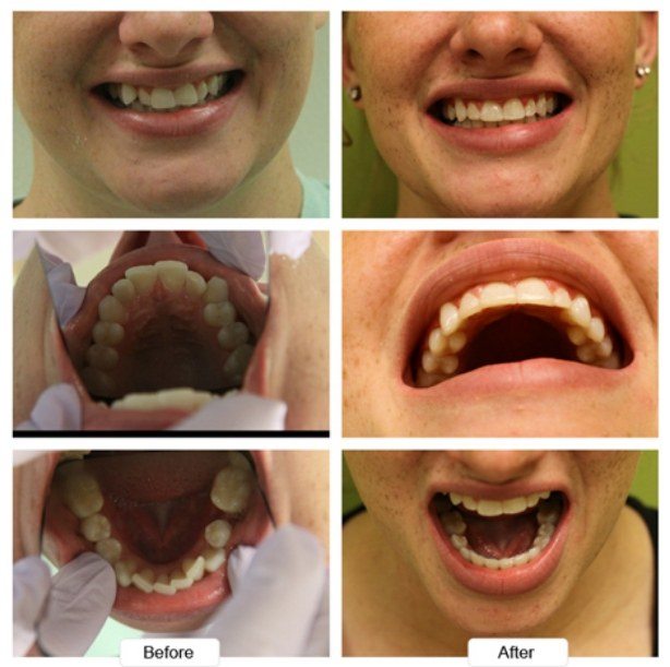 Close up of woman smiling before and after treating misaligned teeth with Invisalign