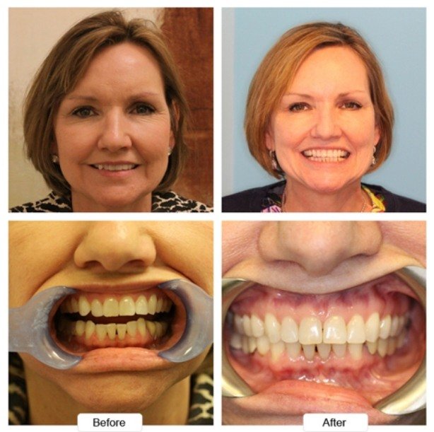 Older woman with short brown hair smiling before and after Invisalign