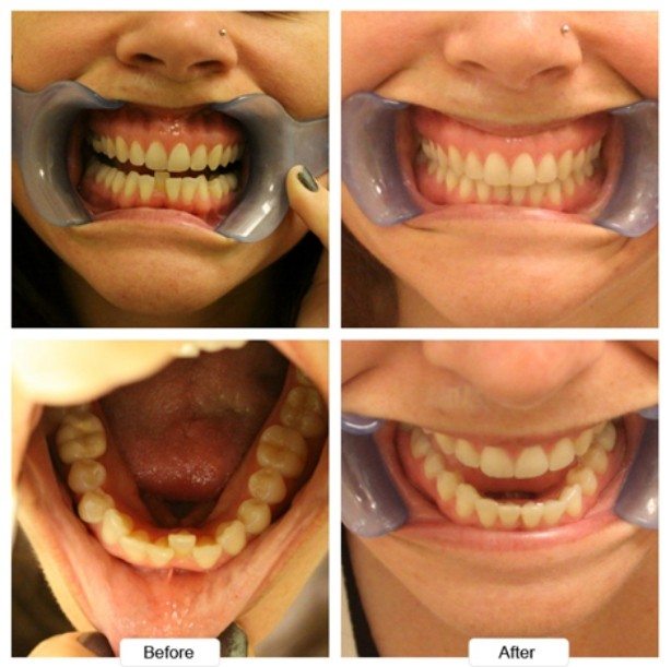 Close up of crowded teeth before and after treatment with Invisalign