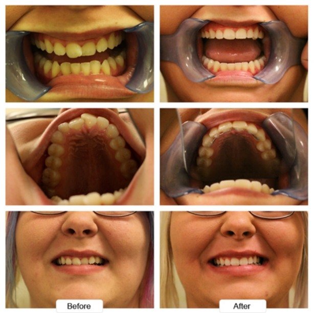 Woman with glasses before and after Invisalign treatment