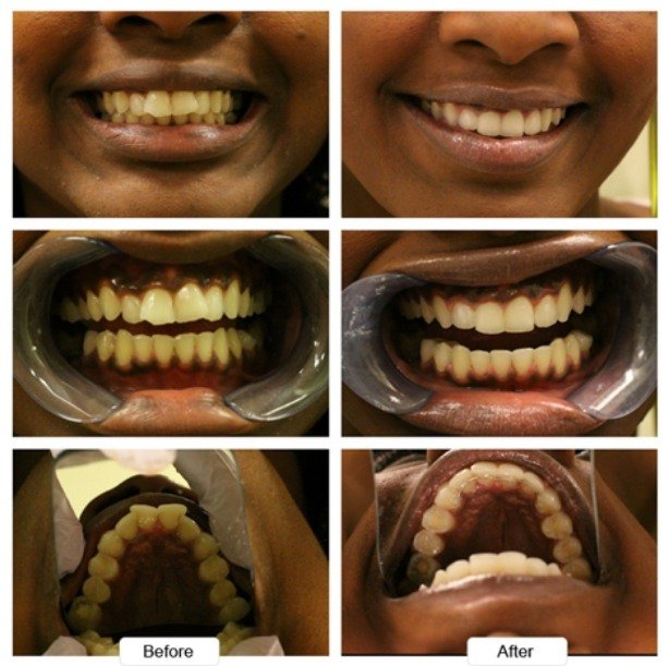Close up of overcrowded teeth before and after Invisalign treatment