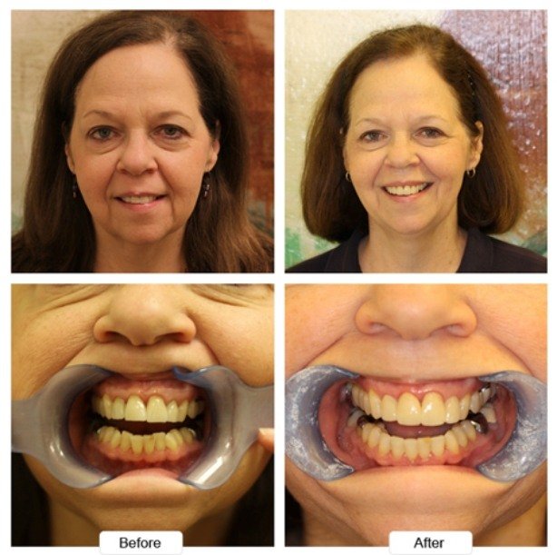 Older brunette woman smiling before and after Invisalign treatment
