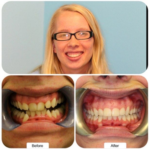 Blonde woman with glasses smiling before and after Invisalign
