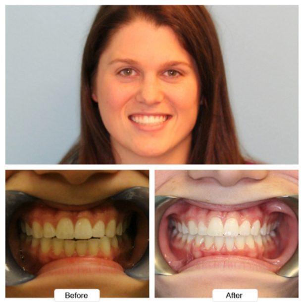 Brunette woman grinning before and after Invisalign