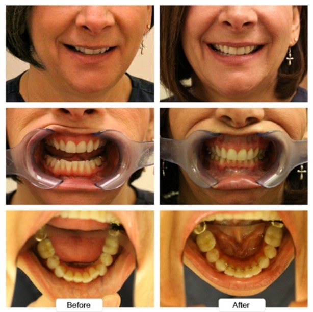 Woman with cross earrings smiling before and after Invisalign