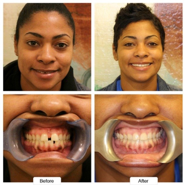 Woman with short hair smiling before and after Invisalign