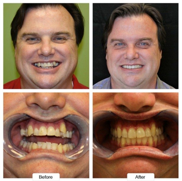 Man with long dark hair grinning before and after Invisalign