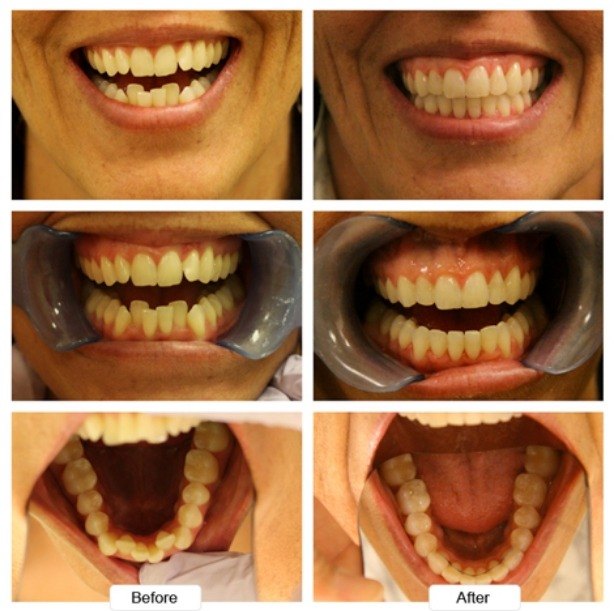 Close up of teeth before and after Invisalign treatment