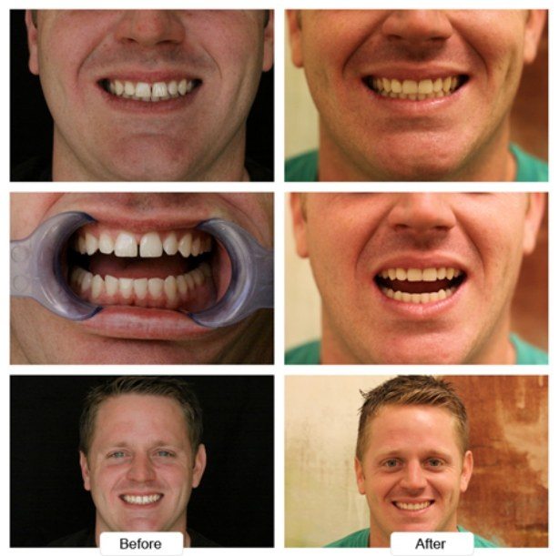 Young man with short blond hair smiling before and after Invisalign