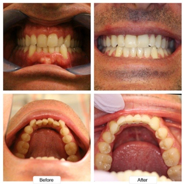 Close up of teeth of man before and after Invisalign