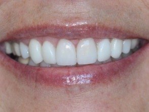 Smile with bright teeth after dental crowns and veneers
