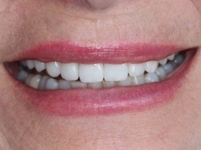 Smile with evenly sized teeth