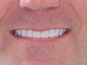 Smile with flawless teeth thanks to dental veneers and crowns