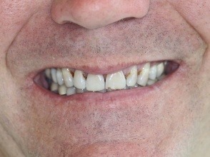 Smile with discolored and damaged teeth