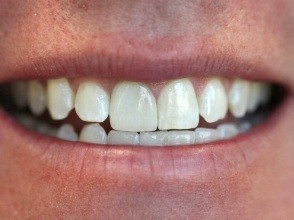 Smile with bright white teeth