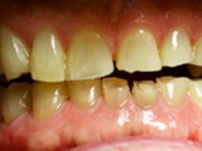 Close up of yellowed chipped teeth