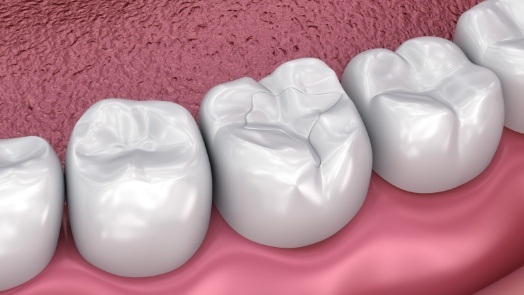 Illustrated row of teeth with dental sealants