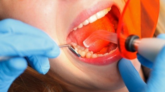 Close up of dentist fixing tooth of patient with dental bonding