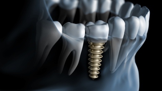 Illustrated X ray of a person with a dental implant in Tulsa