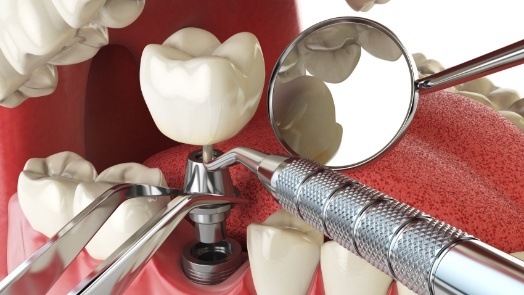 Illustrated dental implant with abutment and crown in lower jaw