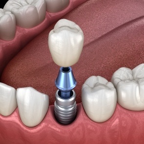 Illustrated dental crown being placed onto a dental implant