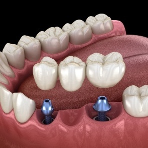 Illustrated dental bridge being placed onto two dental implants