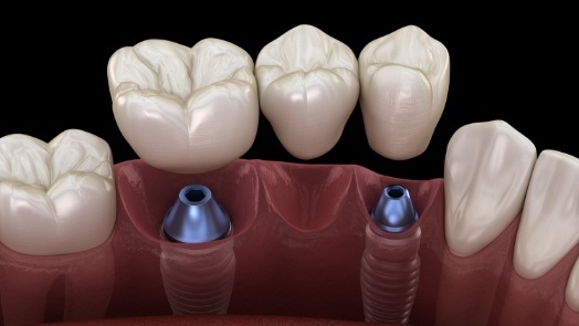 Illustrated dental bridge being fitted over two dental implants