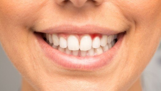 Close up of smile with red spot in gums before gum disease treatment in Tulsa
