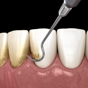 Illustrated dental instrument removing plaque buildup from teeth