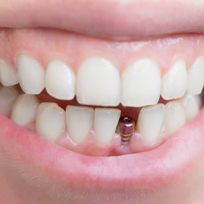 Closeup of a dental implant