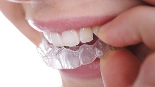 Close up of person placing Invisalign aligner in their mouth