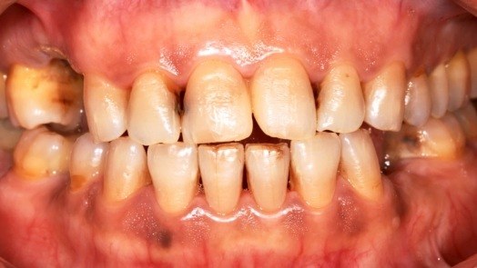 Close up of mouth with receding gums and damaged teeth
