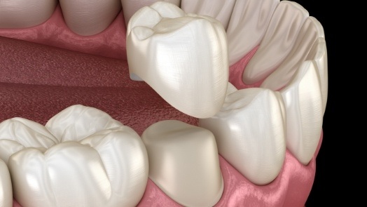 Illustrated dental crown being fitted over a tooth